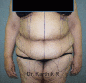 Tummy Tuck