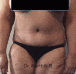 Tummy Tuck