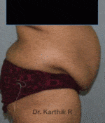 Tummy Tuck