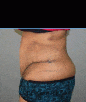 Tummy Tuck