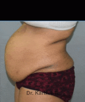 Tummy Tuck