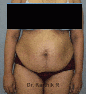 Tummy Tuck