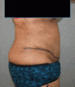 Tummy Tuck