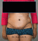 Tummy Tuck