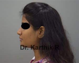 Buccal Fat Removal