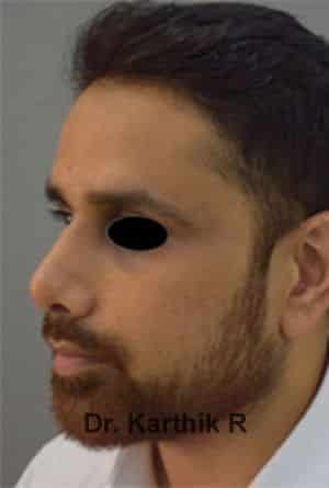 Rhinoplasty (Nose Corrections)