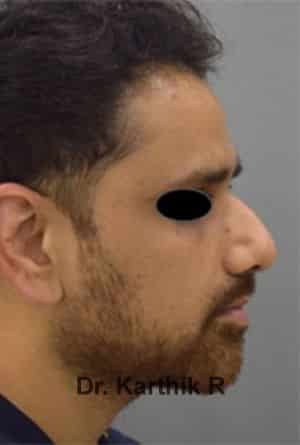 Rhinoplasty (Nose Corrections)
