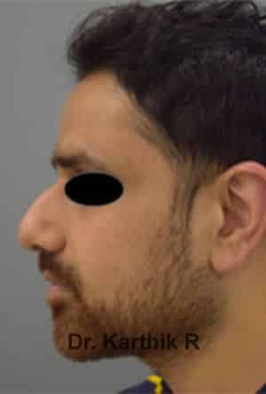 Rhinoplasty (Nose Corrections)