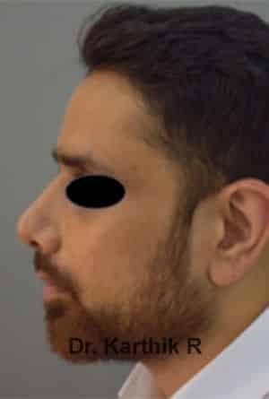Rhinoplasty (Nose Corrections)
