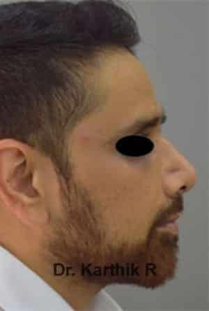 Rhinoplasty (Nose Corrections)