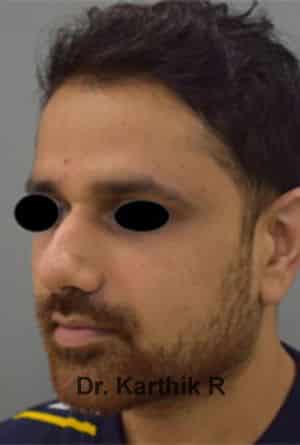 Rhinoplasty (Nose Corrections)