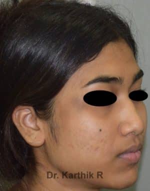 Rhinoplasty (Nose Corrections)