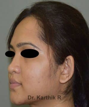 Rhinoplasty (Nose Corrections)