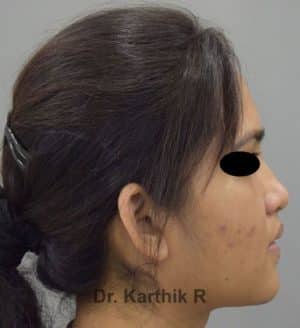 Rhinoplasty (Nose Corrections)