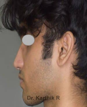 Rhinoplasty (Nose Corrections)