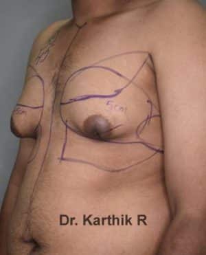 Gynecomastia (Puffy Nipples/ Male Chest Correction)