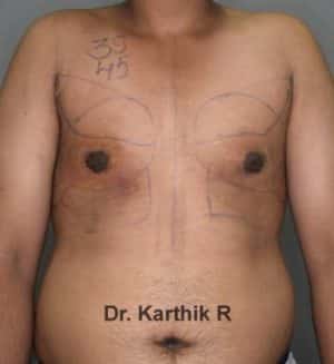 Gynecomastia (Puffy Nipples/ Male Chest Correction)