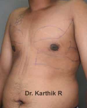 Gynecomastia (Puffy Nipples/ Male Chest Correction)