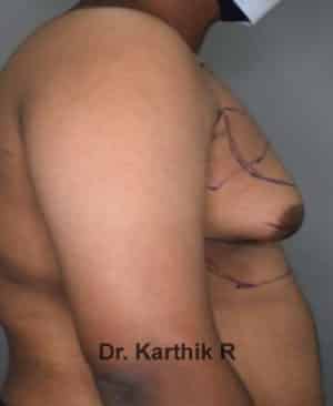 Gynecomastia (Puffy Nipples/ Male Chest Correction)