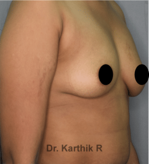 Breast Implants (Breast Augmentation)