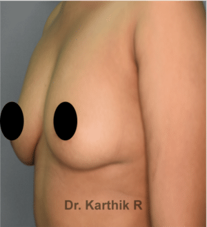 Breast Implants (Breast Augmentation)