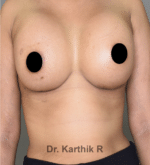 Breast Implants (Breast Augmentation)