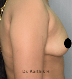 Breast Implants (Breast Augmentation)