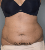 Liposuction Tummy and Back