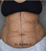 Liposuction Tummy and Back