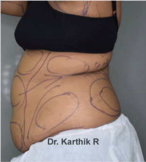 Liposuction Tummy and Back