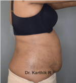 Liposuction Tummy and Back