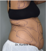 Liposuction Tummy and Back