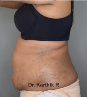 Liposuction Tummy and Back