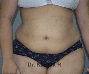 Liposuction