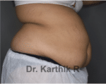 Liposuction