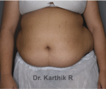 Liposuction