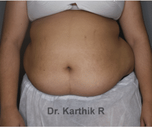 Liposuction