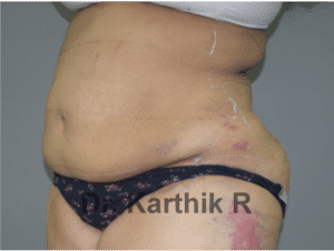 Liposuction