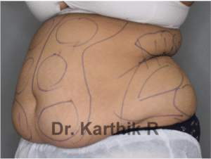Liposuction