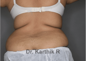 Liposuction