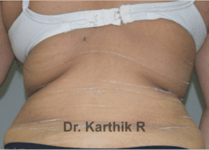 Liposuction