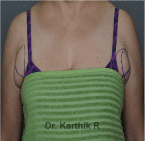 Axillary Tail of Breast