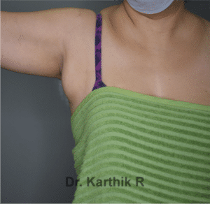 Axillary Tail of Breast