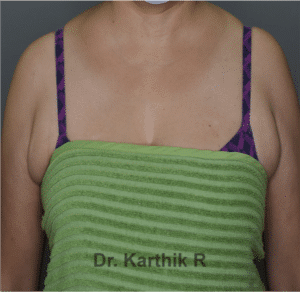 Axillary Tail of Breast