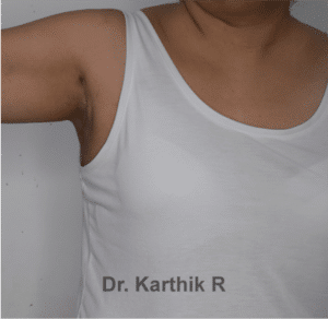 Axillary Tail of Breast