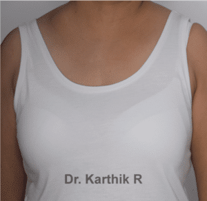 Axillary Tail of Breast