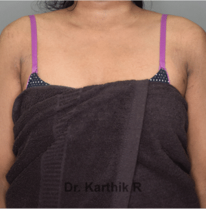 Axillary Tail of Breast
