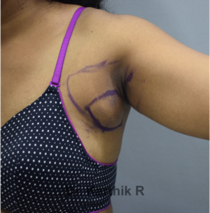 Axillary Tail of Breast