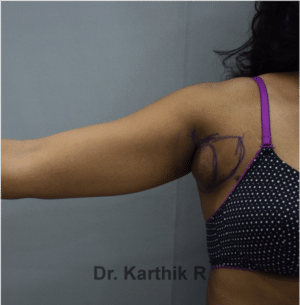 Axillary Tail of Breast
