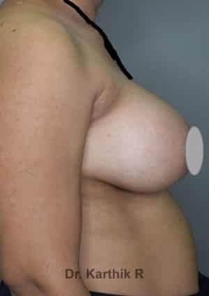 Breast Implants (Breast Augmentation)